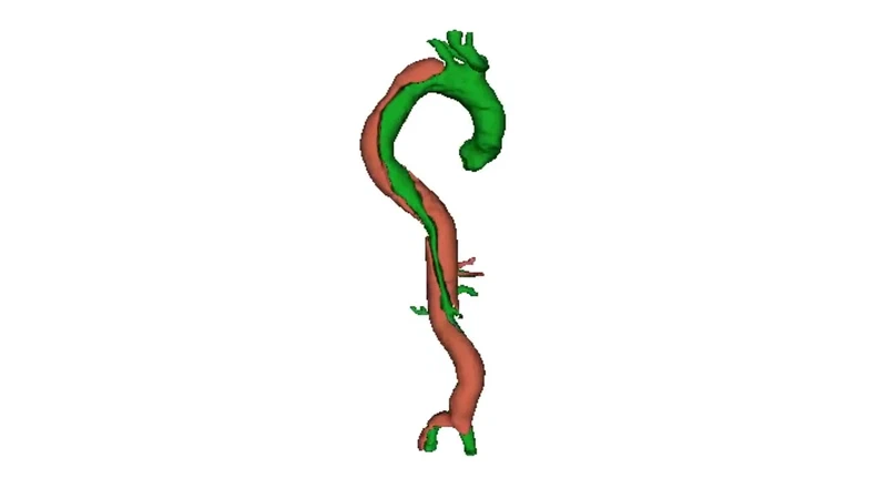 Aortic Dissection Dataset and Segmentations