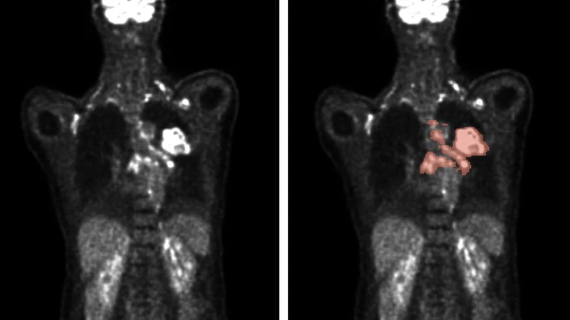 autoPET challenge: algorithms improve medical image analysis